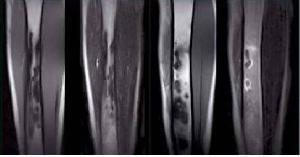 Super Open Permanent Mri System